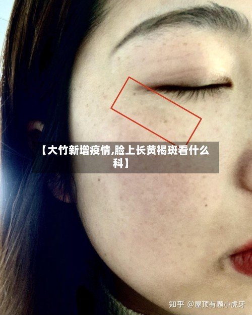 【大竹新增疫情,脸上长黄褐斑看什么科】-第2张图片