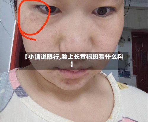 【小强说限行,脸上长黄褐斑看什么科】-第2张图片